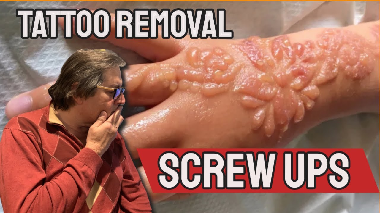 Mustard Tattoo Removal - YouTube